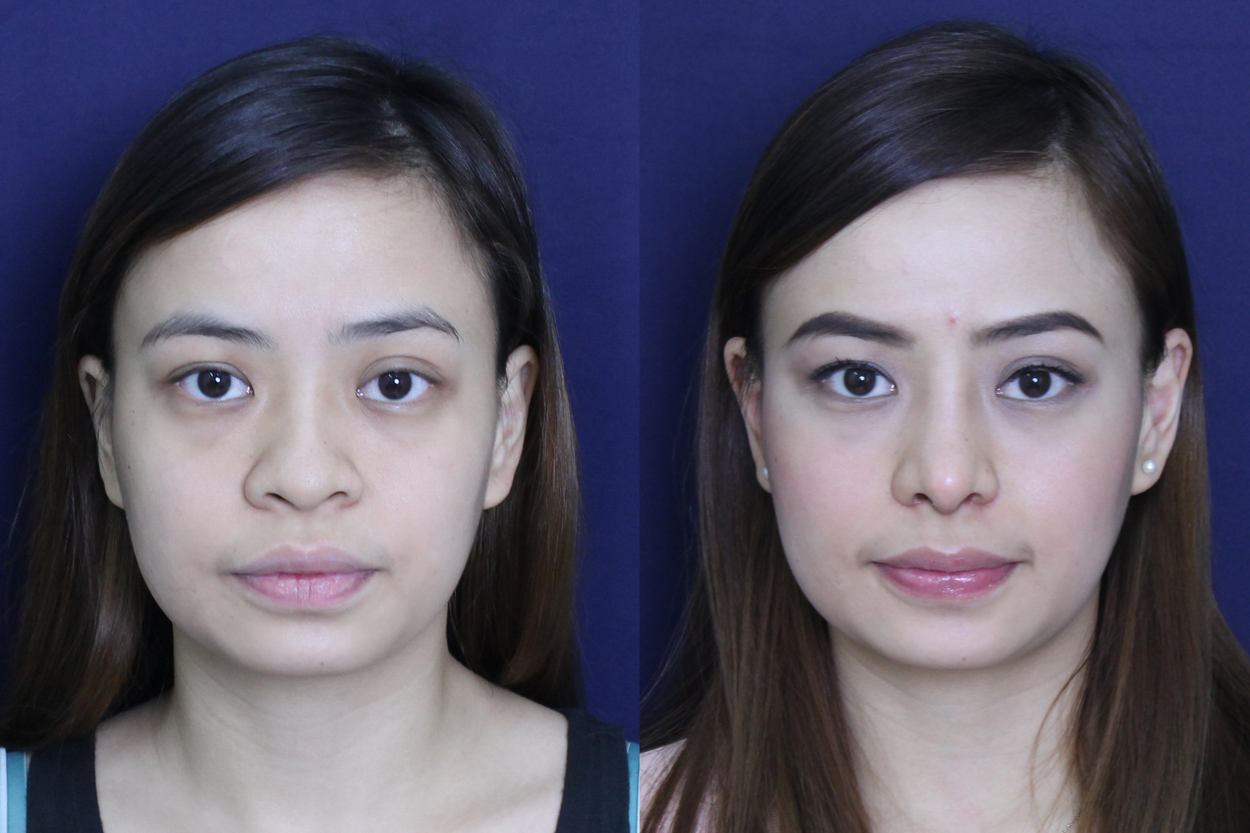 Non surgical nose job is safe & effective. 