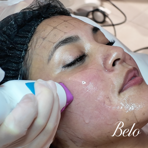 Belo Thermage FLX Treatment