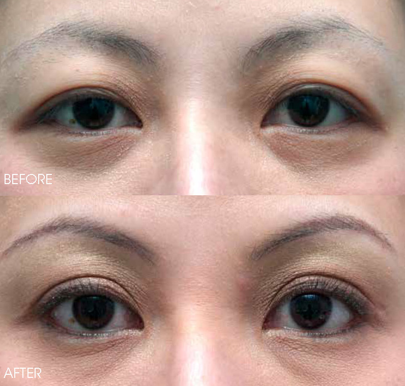 double eyelid surgery philippines