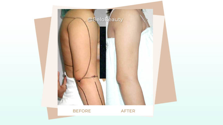 Arm Liposuction Transformation