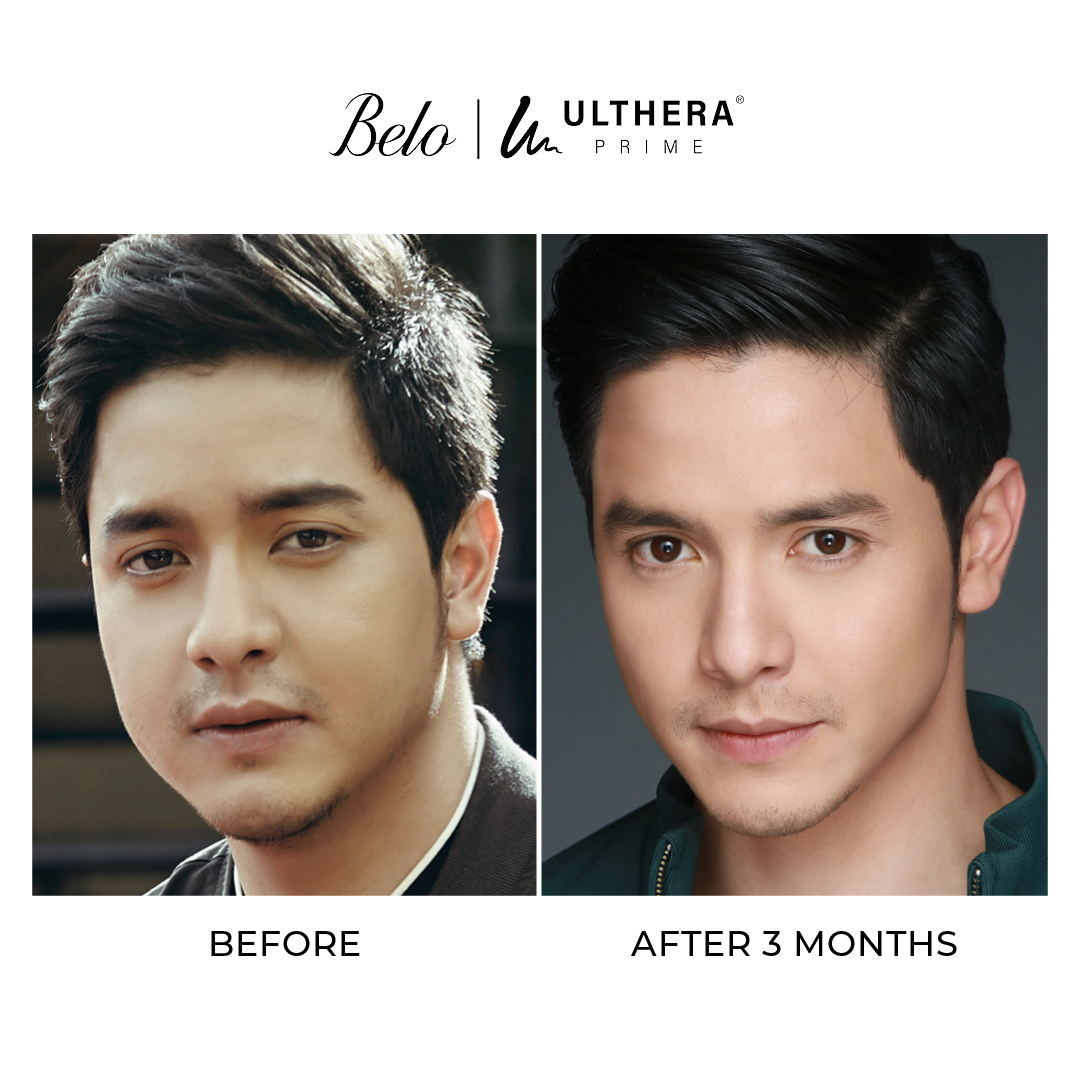 alden richards before and after ulthera treatment