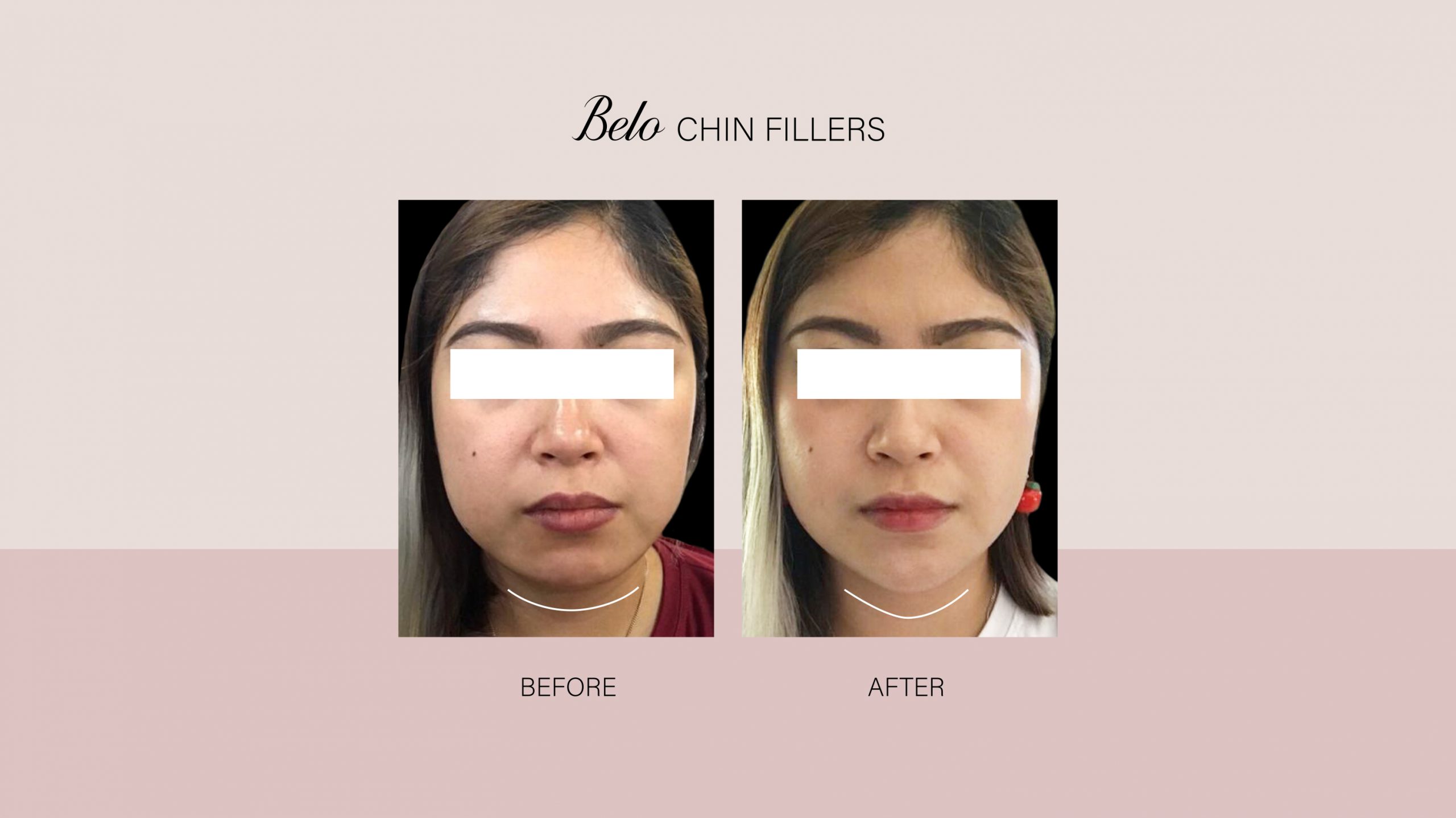 V-Shape Botox Injection (Enhance Facial Contour With Slimmer Jawline)