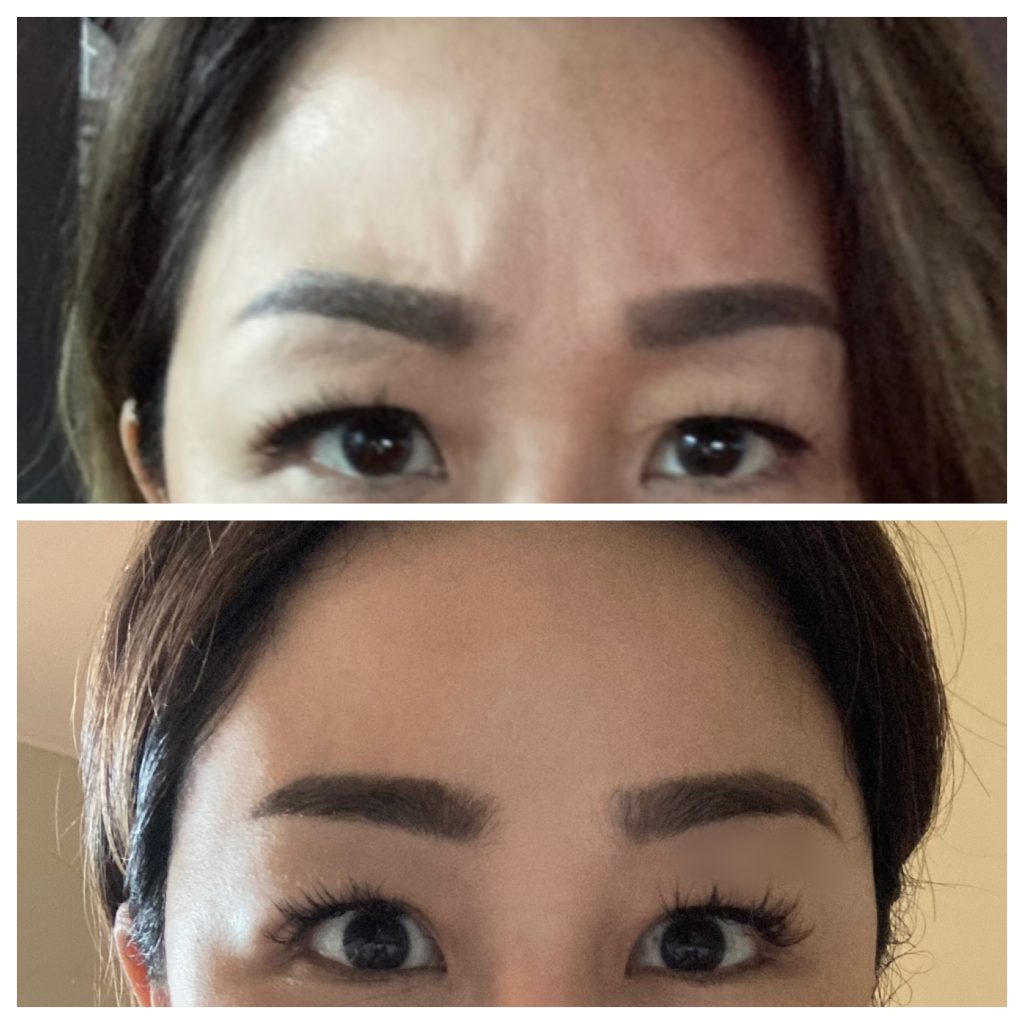 Belo Botox Before and After Result