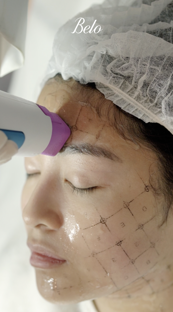 Rei Germar does Belo Thermage FLX