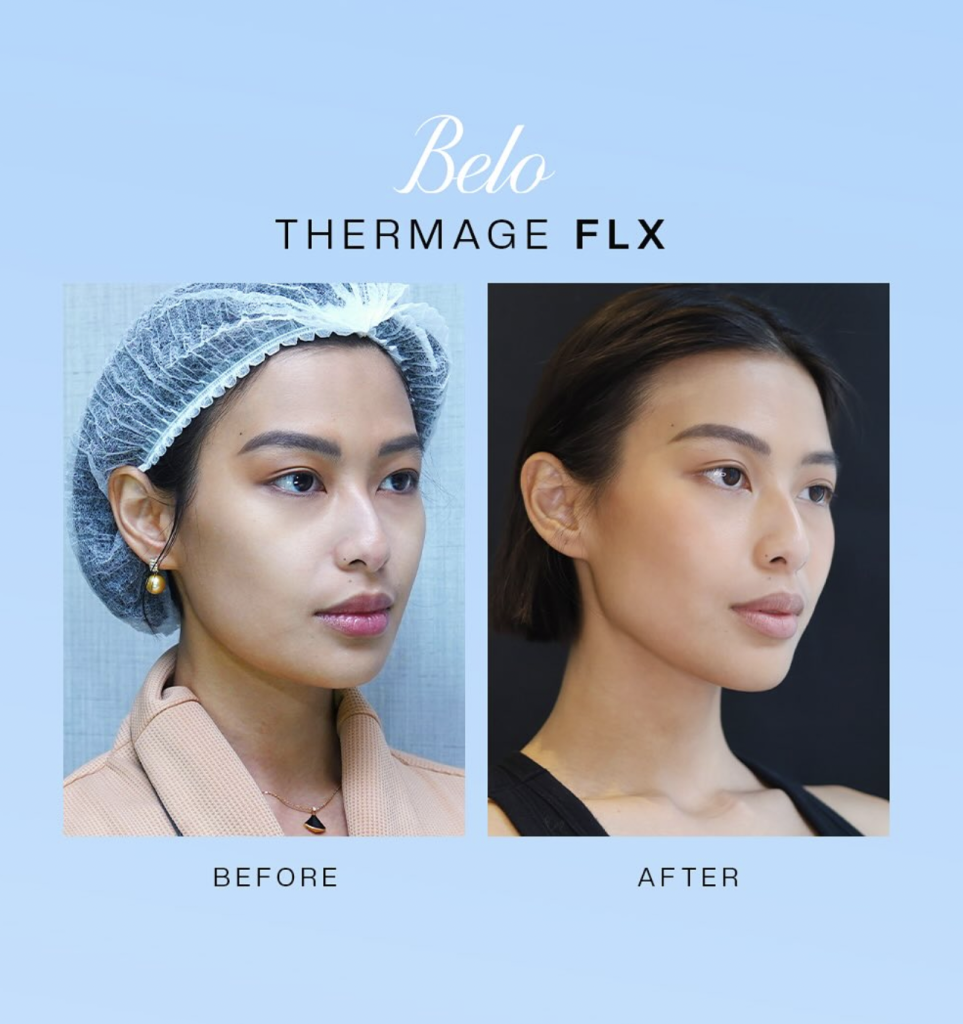 Before and After Results of Thermage FLX