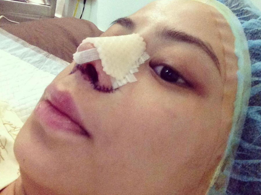 Sam after her rhinoplasty with Dr. Renato "Nato" Pascual
