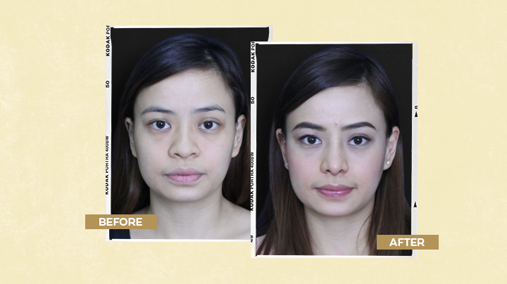 Rhinoplasty Before and After Result