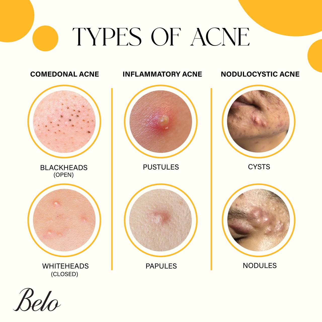 Understanding Acne Common Types And Triggers