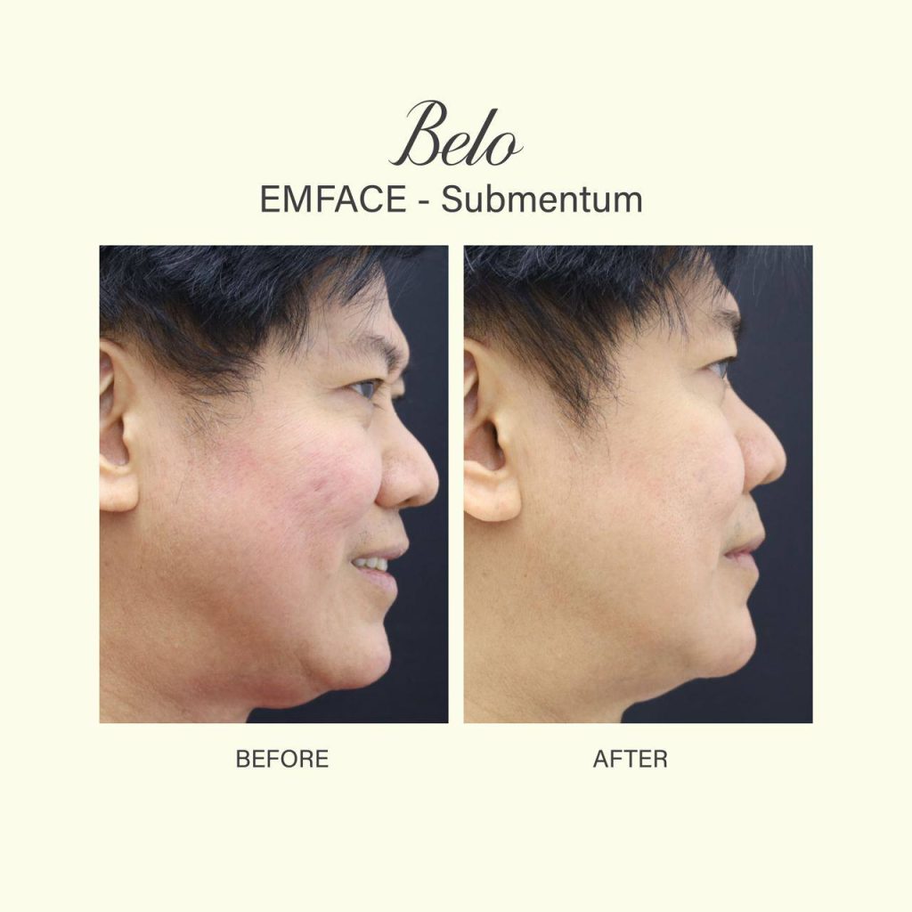 Belo Emface Before and After Results on Man