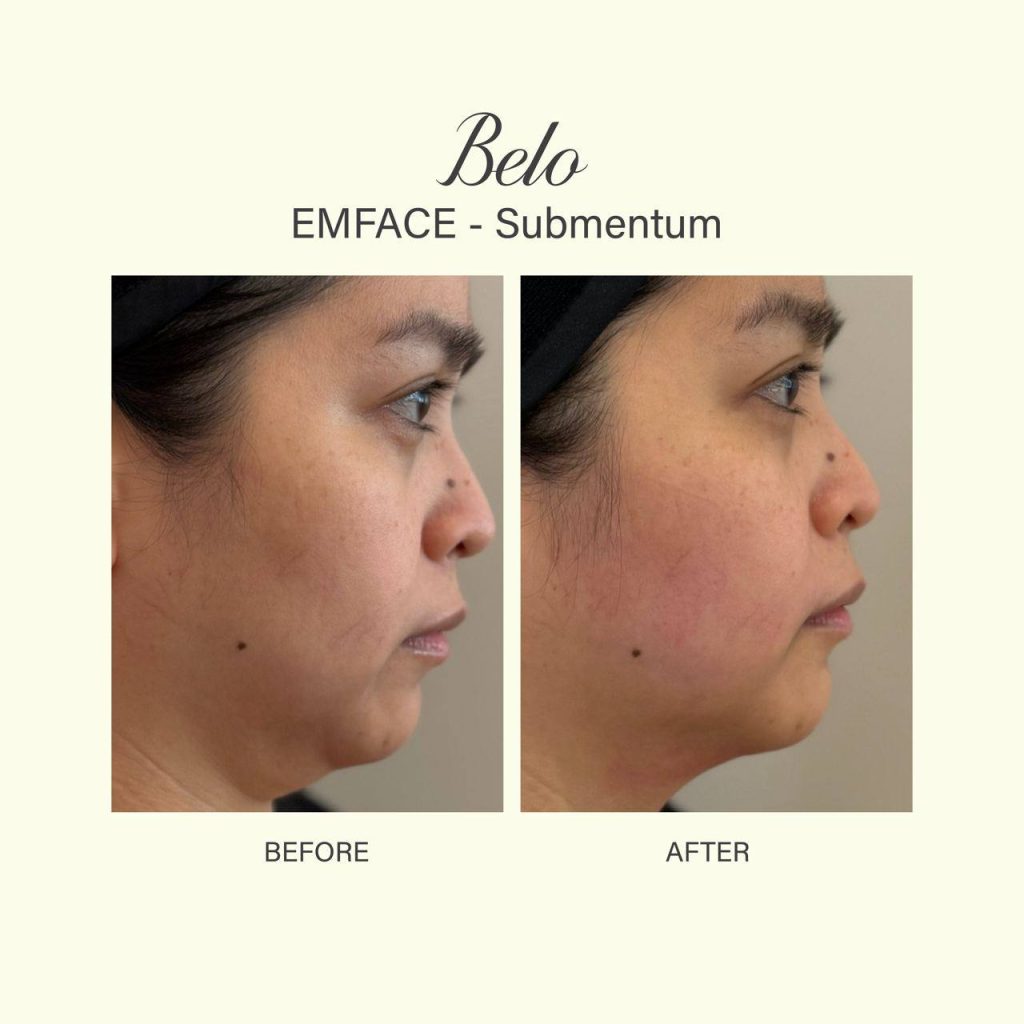 Belo Emface Before and After Results on Woman