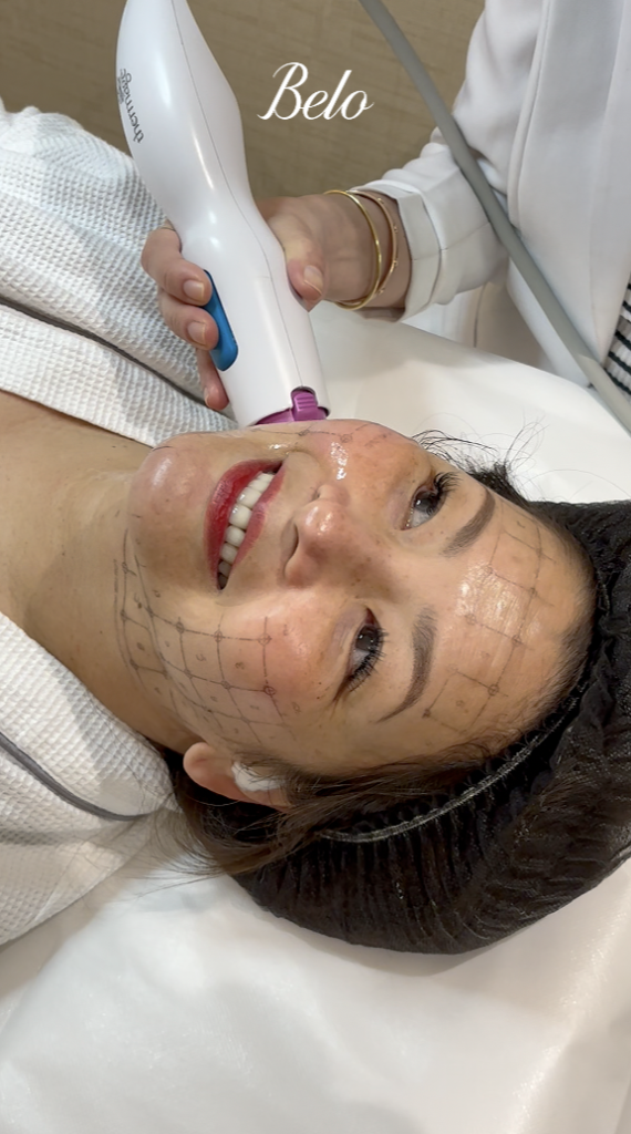 Regine Velasquez with the Thermage FLX Treatment