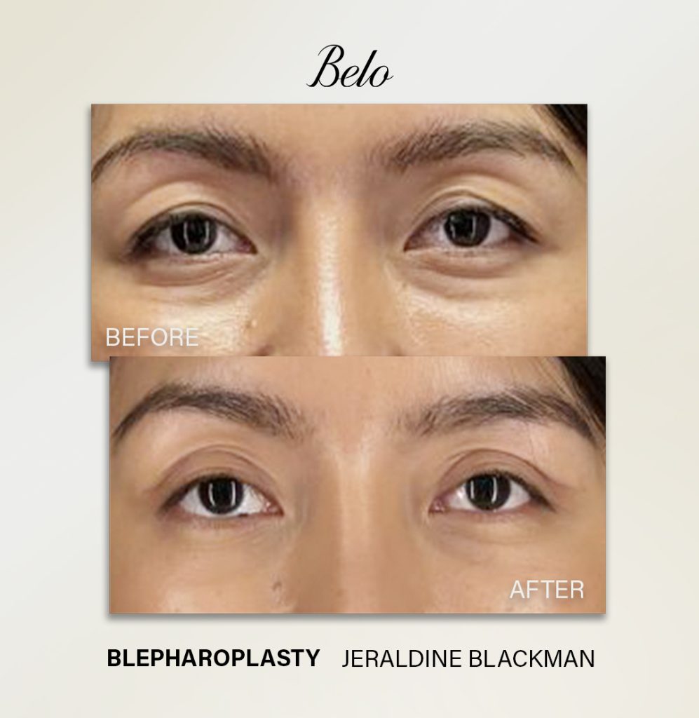 Belo Blepharoplasty Surgery, Belo Eye Surgery