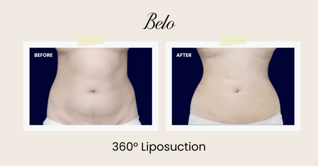 Abdomen Liposuction