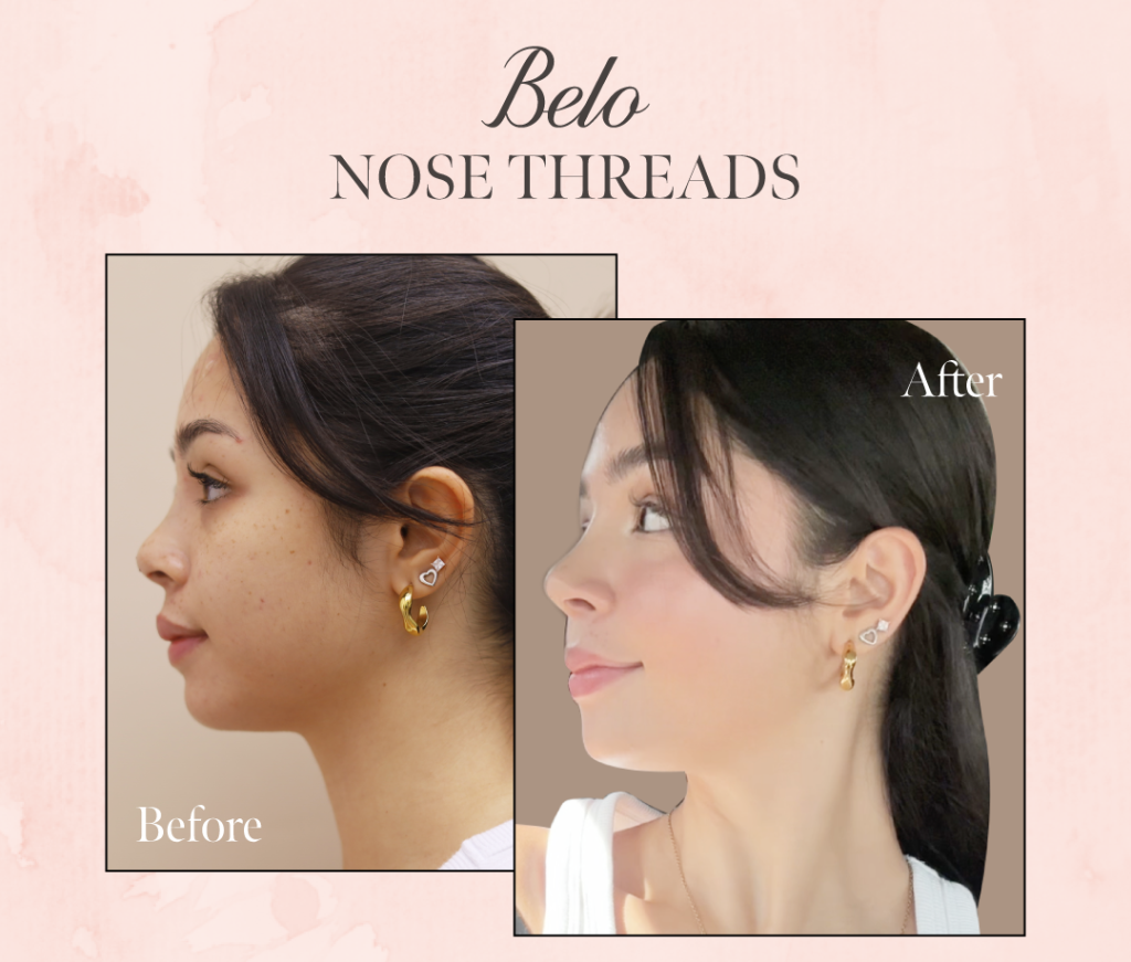 Belo Patient Before and After Nose Threads treatment