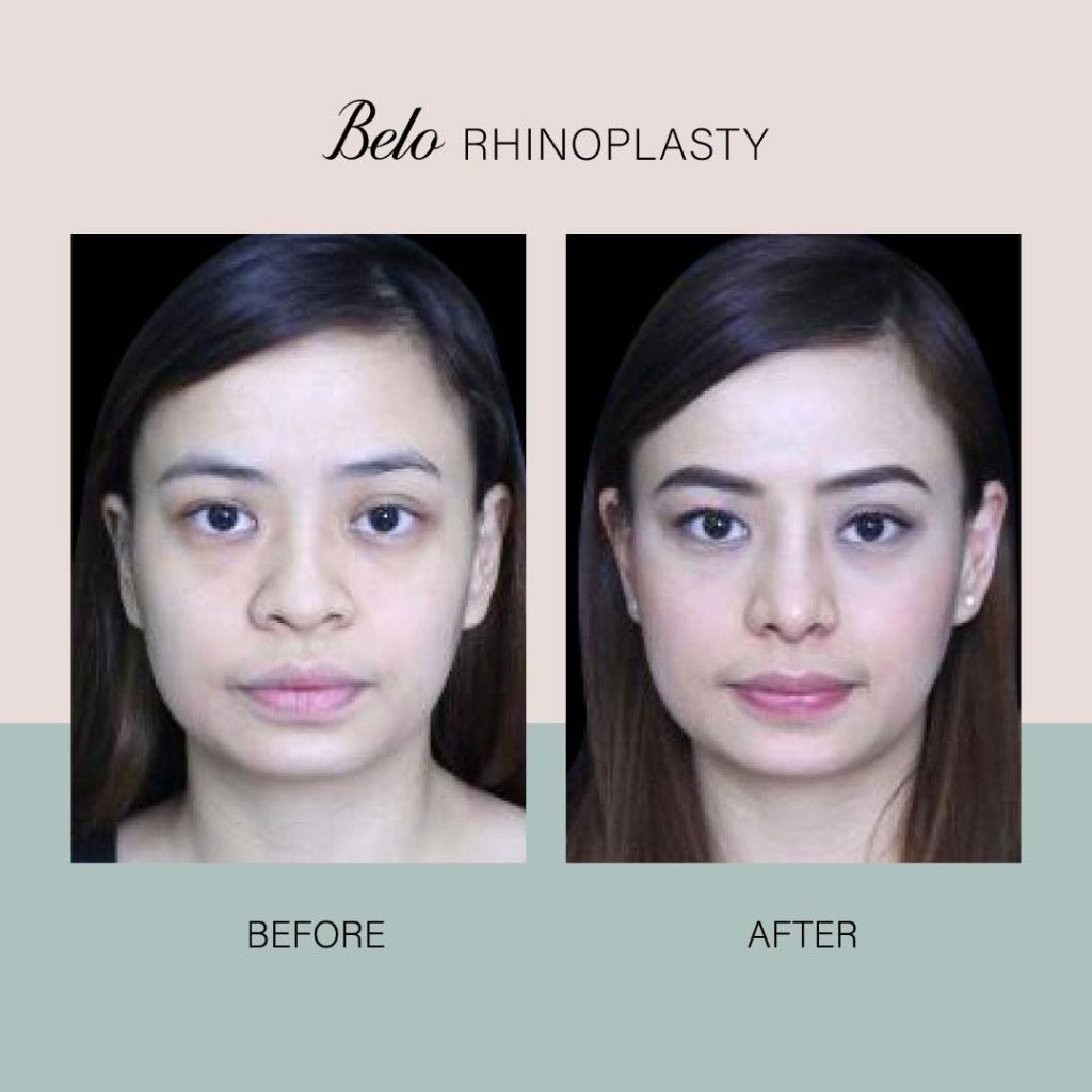 Belo Patient Before and After Rhinoplasty treatment