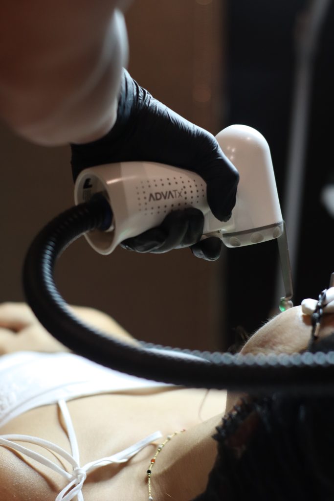 advaclear laser treatment