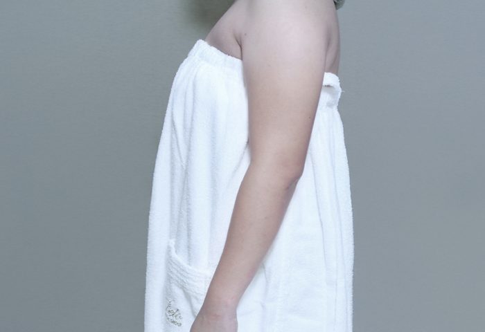 360 Liposuction Arms - After