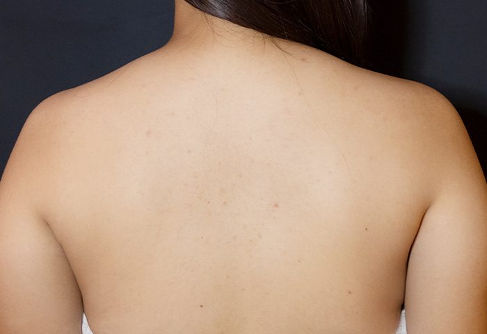 AFTER - Belo BioRePeel