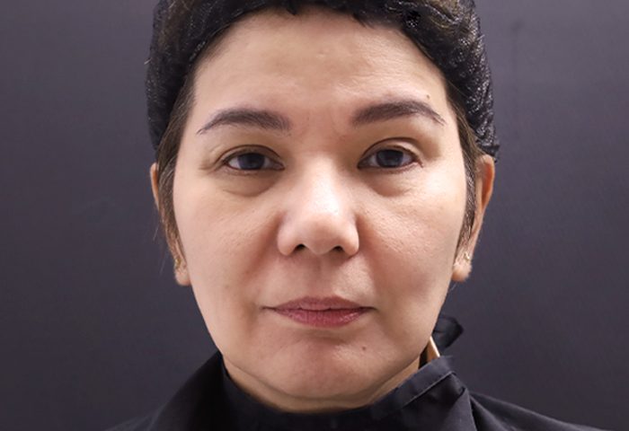 AFTER - Belo Profhilo