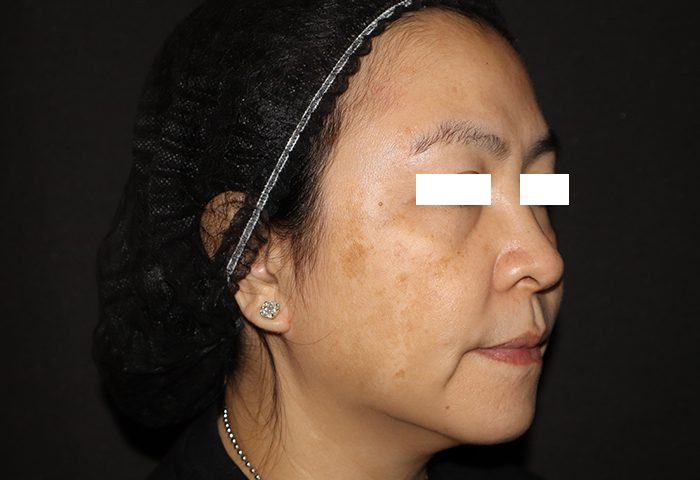 AFTER - Belo Ulthera Prime