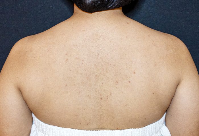 BEFORE - Belo BioRePeel