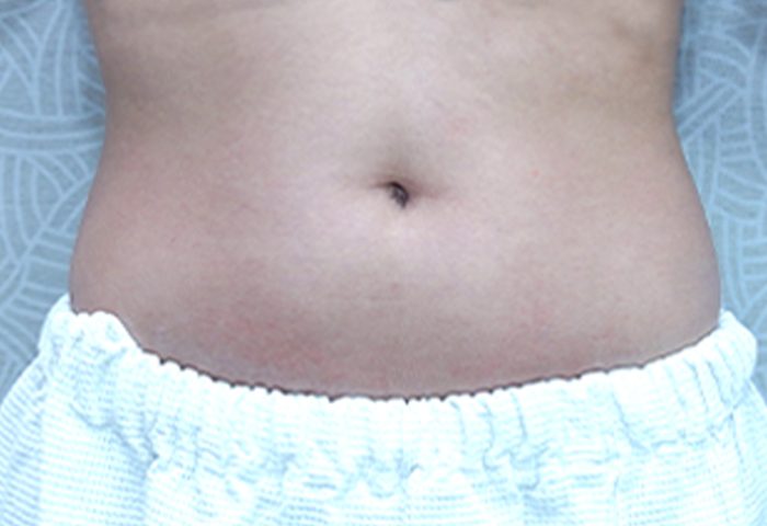 BEFORE - Belo Prime Contour X