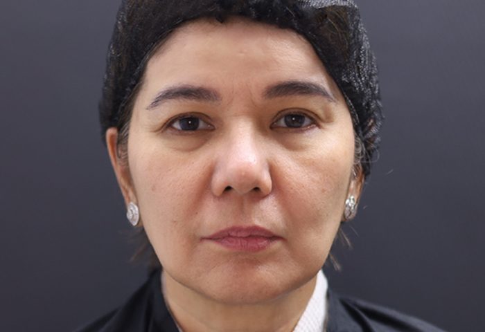 BEFORE - Belo Profhilo