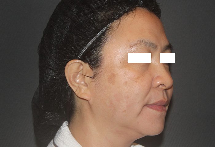 BEFORE - Belo Ulthera Prime