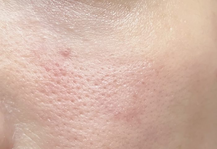 Belo Invisipore - Before
