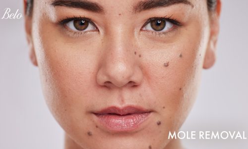 Belo-Mole-removal