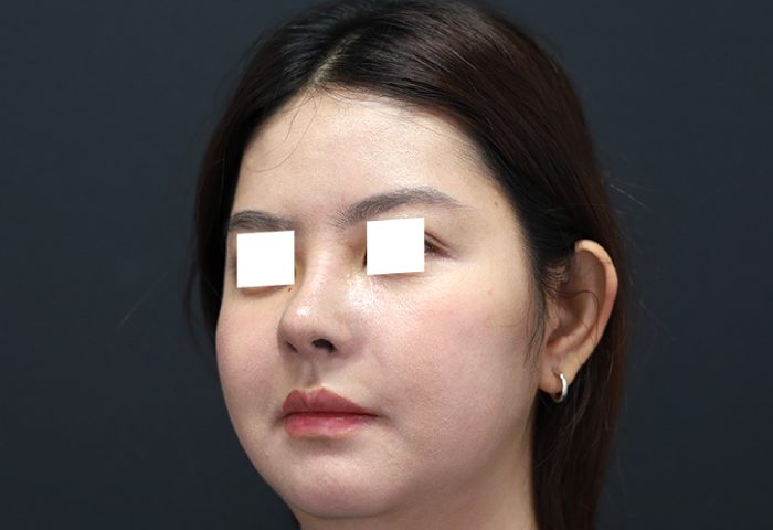 Belo Rhinoplasty - After