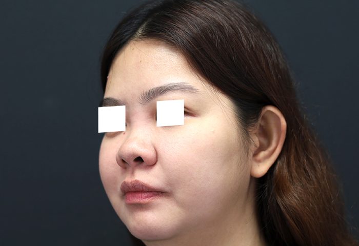 Belo Rhinoplasty - Before