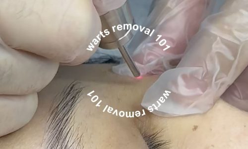 Belo Warts Removal