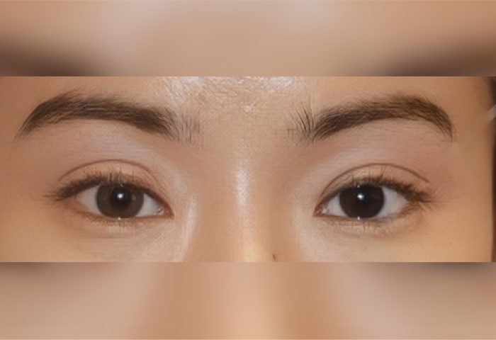 Belo Blepharoplasty - After
