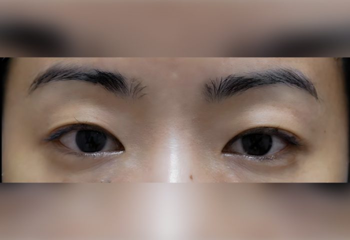 Belo Blepharoplasty - Before