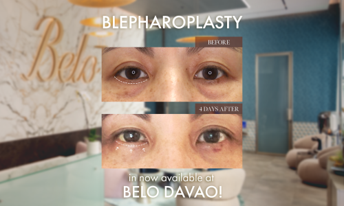 Blepharoplasty Davao