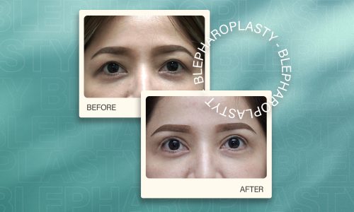 Blepharoplasty