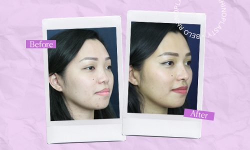 Blog-Julie-Rhinoplasty