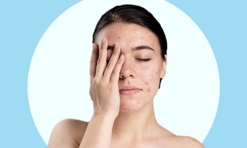 Blog-What-are-the-Common-Types-of-Acne-and-its-Triggers