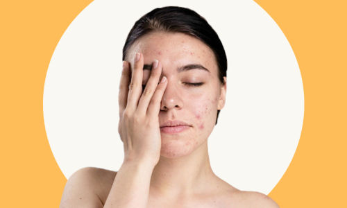 Blog-What-are-the-Common-Types-of-Acne-and-its-Triggers