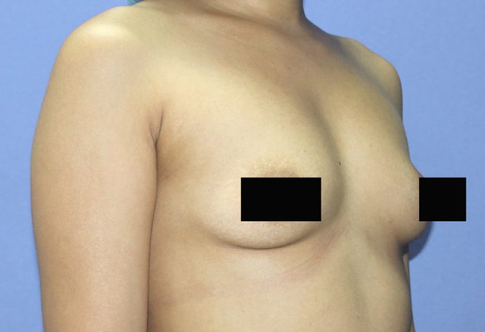 Belo Breast Augmentation - Before