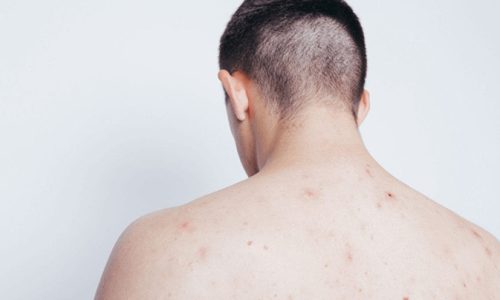 Get Rid Butt Chest Back Acne