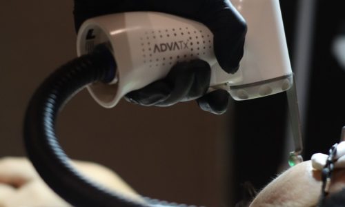 advaclear laser treatment