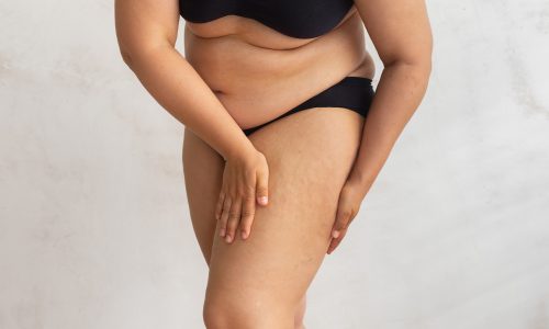 Obesity-in-the-Philippines--How-Weight-Affects-Skin-Health-