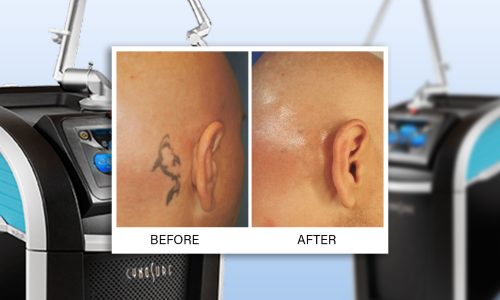 Tattoo-Removal-in-the-Philippines--4-Treatments-To-Try