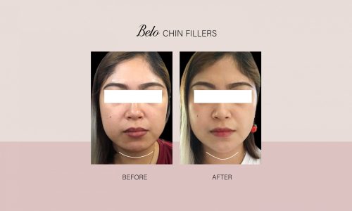 Trish Ong Chin Fillers