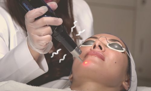 laser treatment acne scars