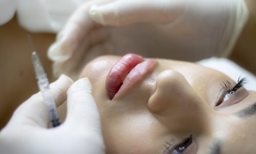 lip-filler-6485474_1280